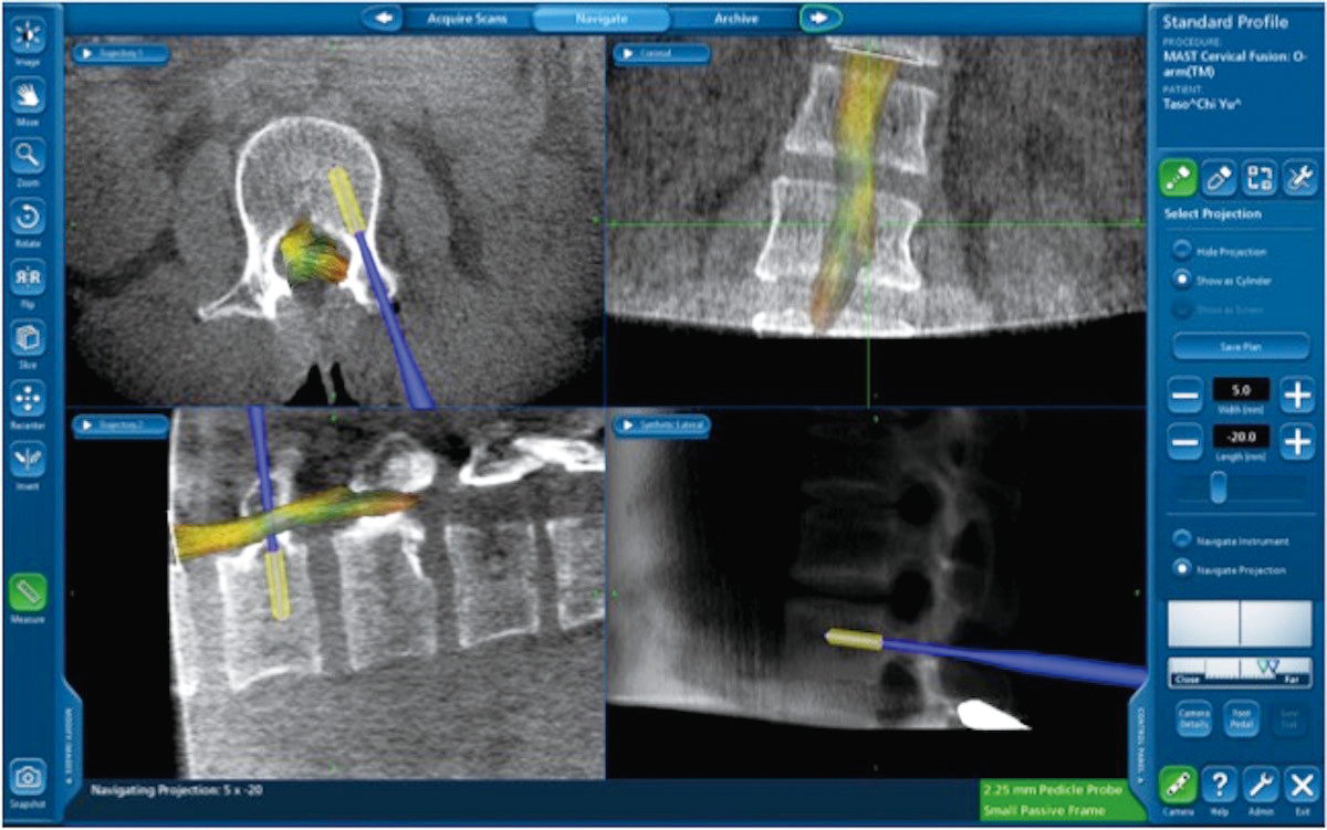 在可視的神經導航導引下手術賦予病患與醫師雙重保障綠色代表植入物藍色為器械黃色為虛擬之脊椎神經